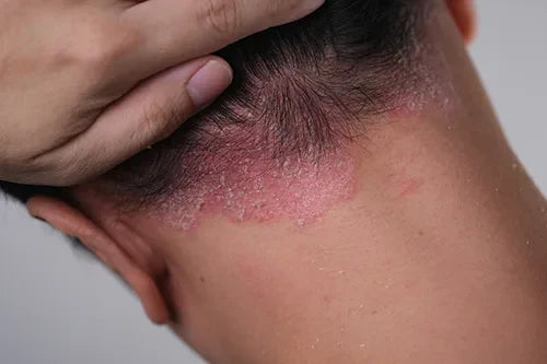Seboreik Dermatit Yönetimi