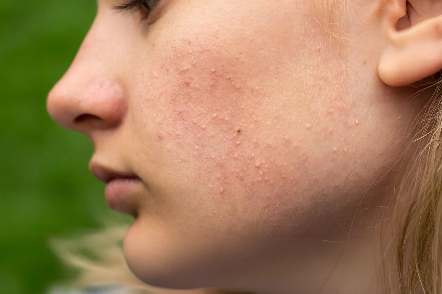 Purging (Cilt Arınması-Kusma Evresi) Nedir? İrritasyon ve Yanlış Reaksiyonlardan Nasıl Ayırt Edilir?